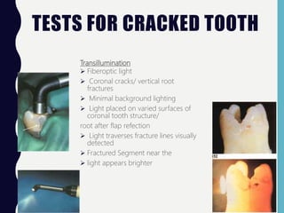 TESTS FOR CRACKED TOOTH
Transillumination
 Fiberoptic light
 Coronal cracks/ vertical root
fractures
 Minimal background lighting
 Light placed on varied surfaces of
coronal tooth structure/
root after flap refection
 Light traverses fracture lines visually
detected
 Fractured Segment near the
 light appears brighter
 
