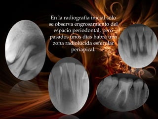 En la radiografía inicial sólo
se observa engrosamiento del
espacio periodontal, pero
pasados unos días habrá una
zona radiolúcida esferular
periapical.
 