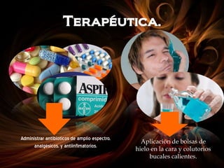 Terapéutica.
Administrar antibióticos de amplio espectro,
analgésicos, y antiinflmatorios.
Aplicación de bolsas de
hielo en la cara y colutorios
bucales calientes.
 
