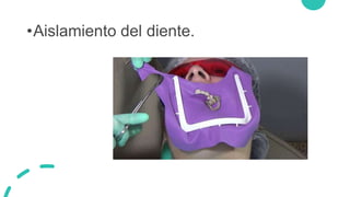 •Aislamiento del diente.
 