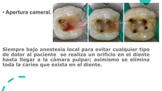 • Apertura cameral.
Siempre bajo anestesia local para evitar cualquier tipo
de dolor al paciente se realiza un orificio en el diente
hasta llegar a la cámara pulpar; asimismo se elimina
toda la caries que exista en el diente.
 