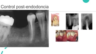 Control post-endodoncia
 