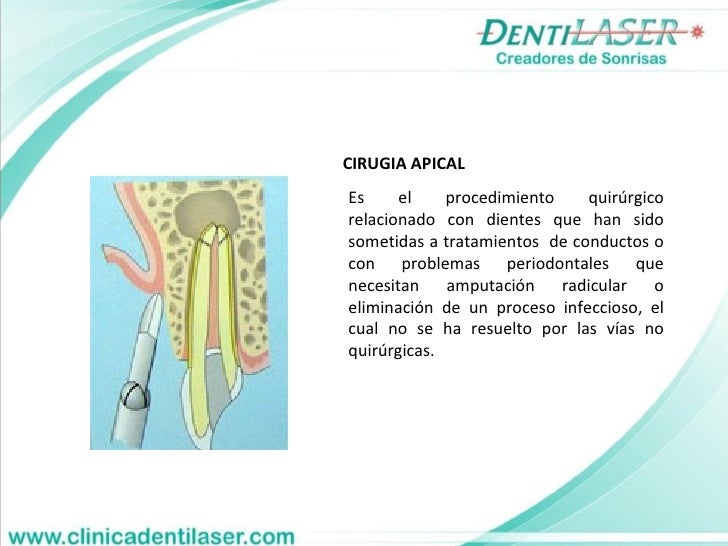 Endodoncia Clinica Odontologica Dentilaser