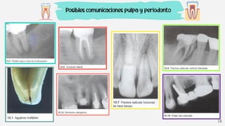 14
Posibles comunicaciones pulpa y periodonto
 