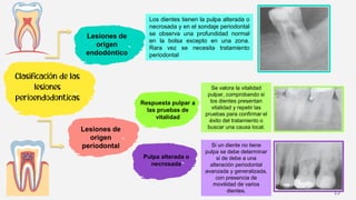 15
Clasificación de las
lesiones
perioendodonticas
Lesiones de
origen
endodóntico
Lesiones de
origen
periodontal
Respuesta pulpar a
las pruebas de
vitalidad
Pulpa alterada o
necrosada
Los dientes tienen la pulpa alterada o
necrosada y en el sondaje periodontal
se observa una profundidad normal
en la bolsa excepto en una zona.
Rara vez se necesita tratamiento
periodontal
Se valora la vitalidad
pulpar, comprobando si
los dientes presentan
vitalidad y repetir las
pruebas para confirmar el
éxito del tratamiento o
buscar una causa local.
Si un diente no tiene
pulpa se debe determinar
si de debe a una
alteración periodontal
avanzada y generalizada,
con presencia de
movilidad de varios
dientes.
 