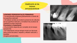 Clasificación de las
lesiones
perioendodonticas
LESIONES PERIODONTALES PRIMARIAS:
- La periodontitis progresa gradualmente a través de
la superficie radicular.
- Al realizar sondeo se revela la presencia de cálculos
en la superficie radicular y al realizar las pruebas de
vitalidad la pulpa responde.
Pronóstico y tratamiento
- El pronóstico depende por completo de la terapia
periodontal.
- El Tratamiento incluye terapia inicial con técnicas
para control de placa, raspado y alisado radicular y
posibles
cirugías periodontales.
 