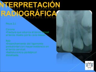 NTERPRETACIÓN
RADIOGRÁFICA
Pieza 2.1
Corona
•Fractura que abarca el tercio incisal
al tercio medio porla cara mesial.
Raíz
•Ensanchamiento del ligamento
periodontal con mayor evidencia en
el tercio cervical.
•Radiolucencia perialpical
distalizada.
 