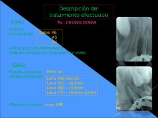 Descripción del
tratamiento efectuado
Tec. CROWN DOWN
•Colocación de HidroxidoCa
•Sellado coronal con ionomero de vidrio.
19.5 mm
•Prueba de cono: cono #80
Gates #6
#5
#4
Lima #50 (inicial)
Lima #55 –19.5mm
Lima #60 –19.5mm
Lima #70 –19.5mm (LMA)
Cita#1
•Acceso
•Crowndown
Cita#2
•Conductometría:
•Reintrumentación:
 