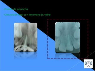 •Prueba de penacho
•Obturación final con ionomero de vidrio
 