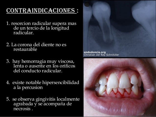 Endodoncia pediatrica