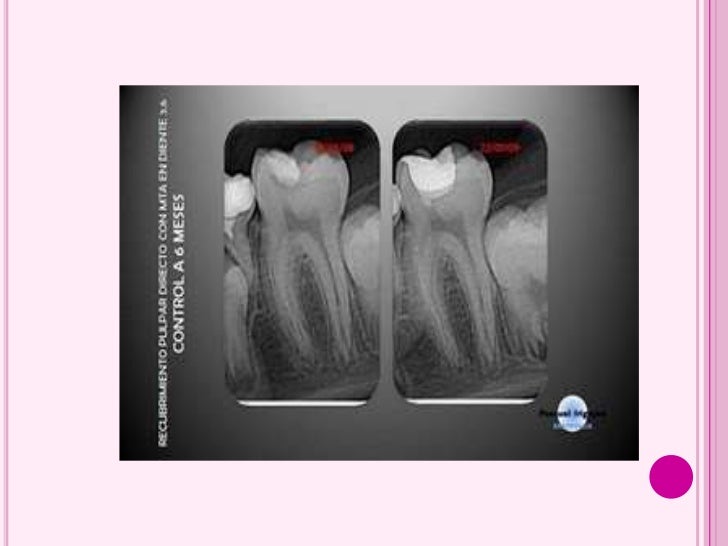 Endodoncia preventiva