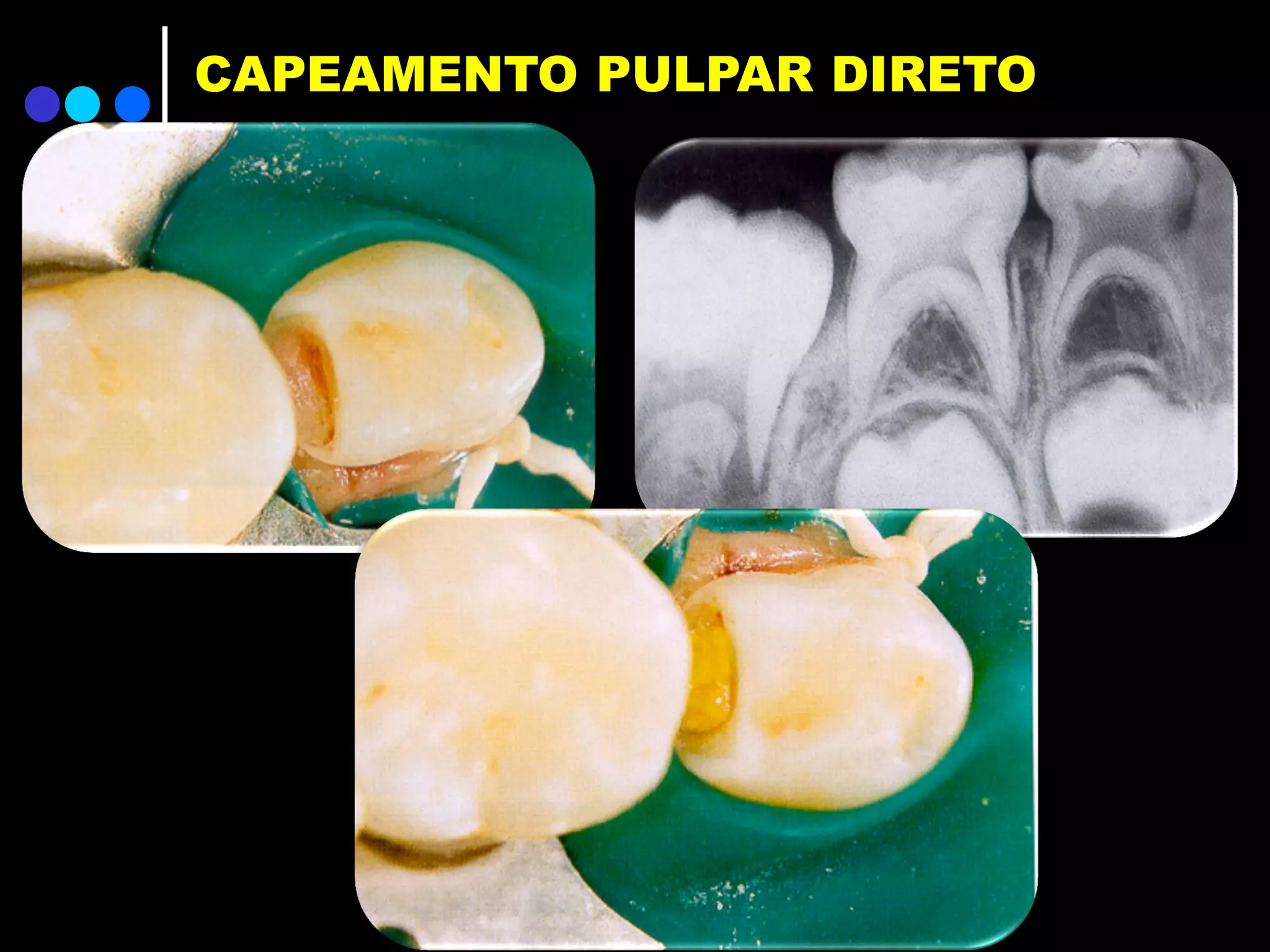 Endodontia em odontopediatria - tratamento pulpar dente decíduo | PDF