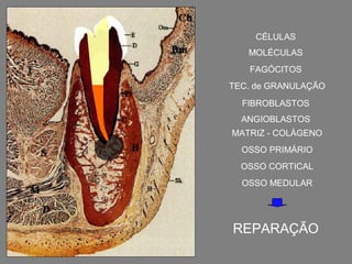 CÉLULAS
   MOLÉCULAS
   FAGÓCITOS
TEC. de GRANULAÇÃO
  FIBROBLASTOS
  ANGIOBLASTOS
MATRIZ - COLÁGENO
  OSSO PRIMÁRIO
  OSSO CORTICAL
  OSSO MEDULAR




REPARAÇÃO
 