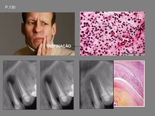 P.130




        TREFINAÇÃO
 