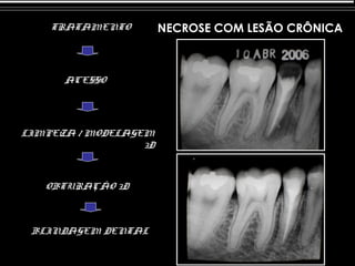 TRATAMENTO         NECROSE COM LESÃO CRÔNICA



      ACESSO




LIMPEZA / MODELAGEM
                  3D



   OBTURAÇÃO 3D



 BLINDAGEM DENTAL
 