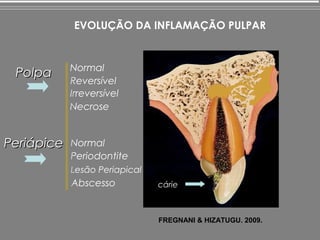 EVOLUÇÃO DA INFLAMAÇÃO PULPAR


            Normal
 Polpa
            Reversível
            Irreversível
            Necrose


Periápice   Normal
            Periodontite
            Lesão Periapical
            Abscesso           cárie



                               FREGNANI & HIZATUGU. 2009.
 