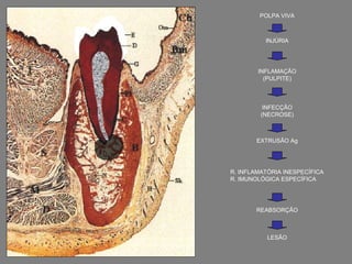 POLPA VIVA



          INJÚRIA




        INFLAMAÇÃO
          (PULPITE)



          INFECÇÃO
         (NECROSE)



       EXTRUSÃO Ag




R. INFLAMATÓRIA INESPECÍFICA
R. IMUNOLÓGICA ESPECÍFICA




       REABSORÇÃO



           LESÃO
 