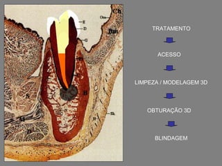 TRATAMENTO



      ACESSO




LIMPEZA / MODELAGEM 3D




   OBTURAÇÃO 3D




      BLINDAGEM
 