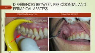 DIFFERENCES BETWEEN PERIODONTAL AND
PERIAPICAL ABSCESS
PERIODONTAL ABSCESS PERIAPICAL ABSCESS
Periodontal pocket is present caries/ fracture is present
May occur after periodontal treatment May occur after endodontic or restorative
Tooth is vital Tooth is non - vital
Pain is usually dull and localized Pain is severe and difficult to localize
Swelling is present on the lateral surface of root
usually without fistulous track as abscess usually
drains from pocket opening.
Swelling is present at the apical portion of tooth
which drains by formation of a fistulous track.
Tender on lateral percussion Tender on vertical percussion
Usually not visible on radiographs Appears as a periapical radiolucency
16/27
 