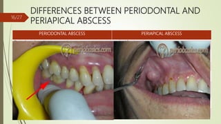 DIFFERENCES BETWEEN PERIODONTAL AND
PERIAPICAL ABSCESS
PERIODONTAL ABSCESS PERIAPICAL ABSCESS
Periodontal pocket is present caries/ fracture is present
May occur after periodontal treatment May occur after endodontic or restorative
Tooth is vital Tooth is non - vital
Pain is usually dull and localized Pain is severe and difficult to localize
Swelling is present on the lateral surface of root
usually without fistulous track as abscess usually
drains from pocket opening.
Swelling is present at the apical portion of tooth
which drains by formation of a fistulous track.
Tender on lateral percussion Tender on vertical percussion
Usually not visible on radiographs Appears as a periapical radiolucency
16/27
 