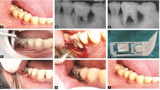 Endodontic-Periodontic Lesions-ediated.pptx