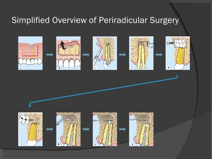 Endodontic Surgery