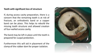 Cuspal Protection Endodontic Access Cavity.pptx