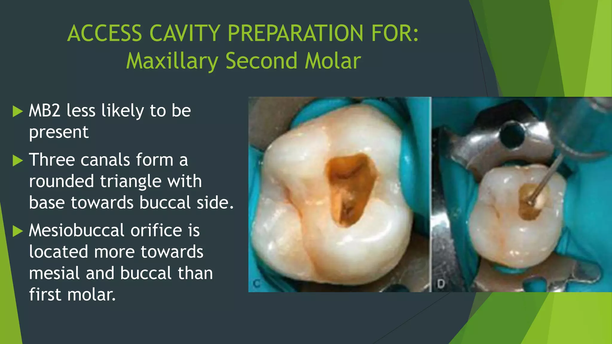 Endodontic Access Cavity Preparation PPTX