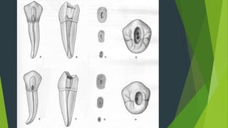 Endodontic Access Cavity Preparation | PPTX