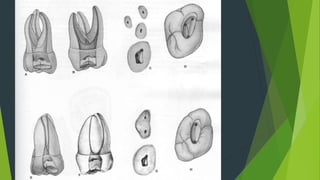 Endodontic Access Cavity Preparation | PPTX