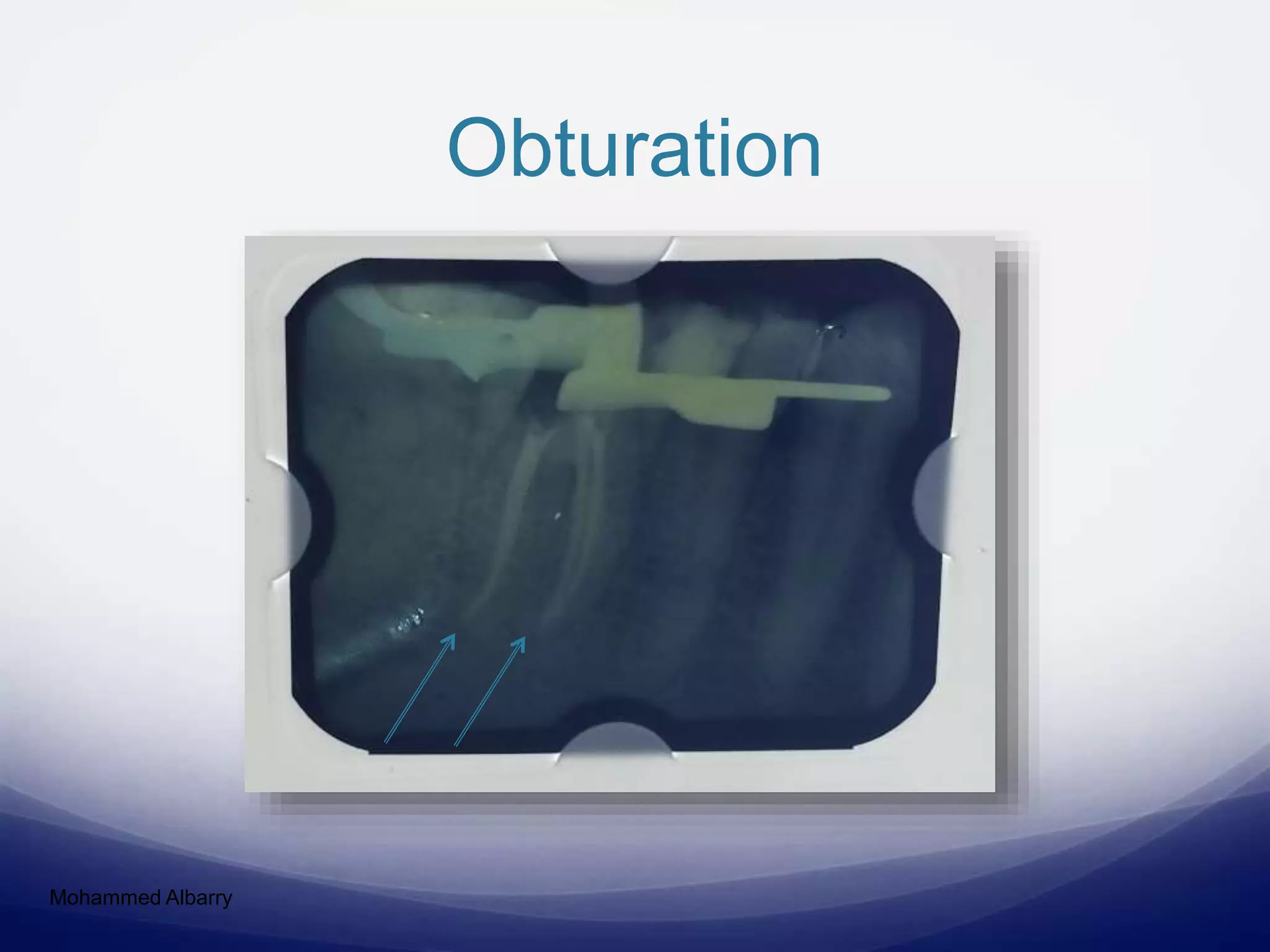 Obturation
Mohammed Albarry
 