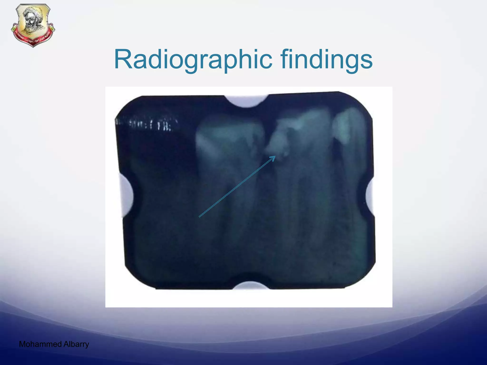 Radiographic findings
Mohammed Albarry
 