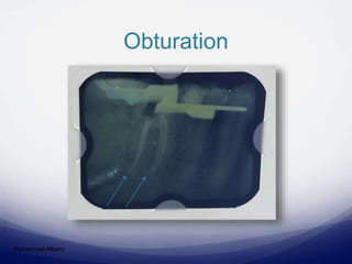 Obturation
Mohammed Albarry
 