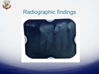 Radiographic findings
Mohammed Albarry
 