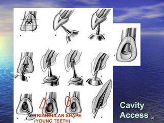 Cavity
TRIANGULAR SHAPE   Access   26
(YOUNG TEETH)
 