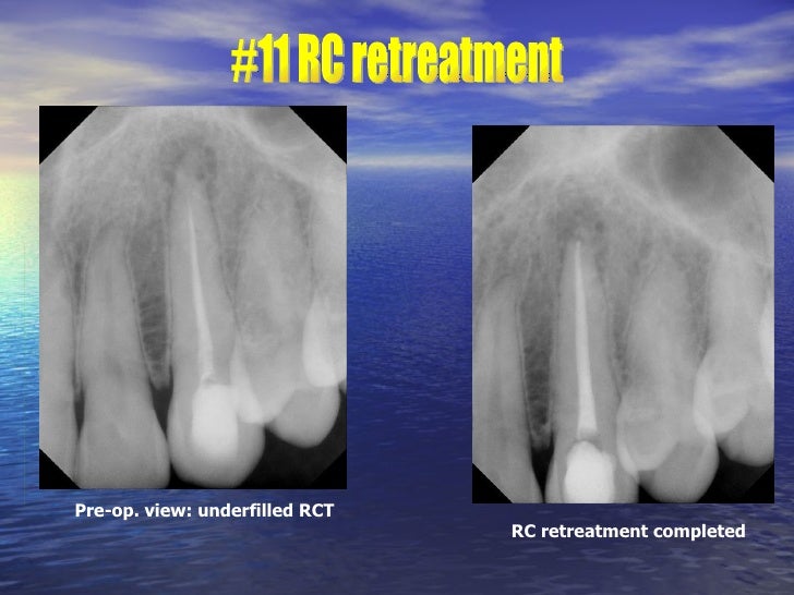 Endodontic Clinical Cases