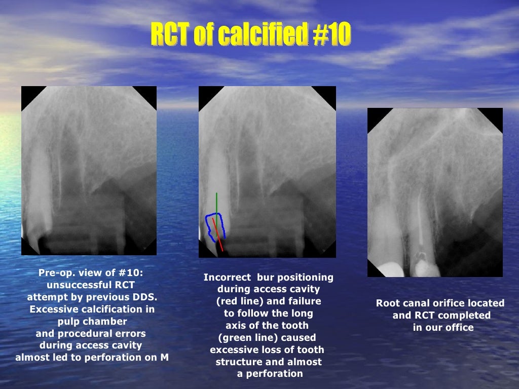 Endodontic Clinical Cases