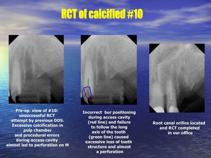 Endodontic Clinical Cases