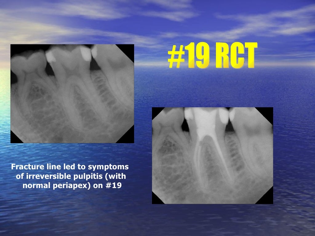 Endodontic Clinical Cases