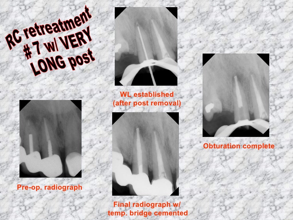 Endodontic clinical cases 2