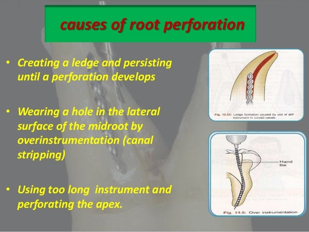 endodontic perforation perforating stripping