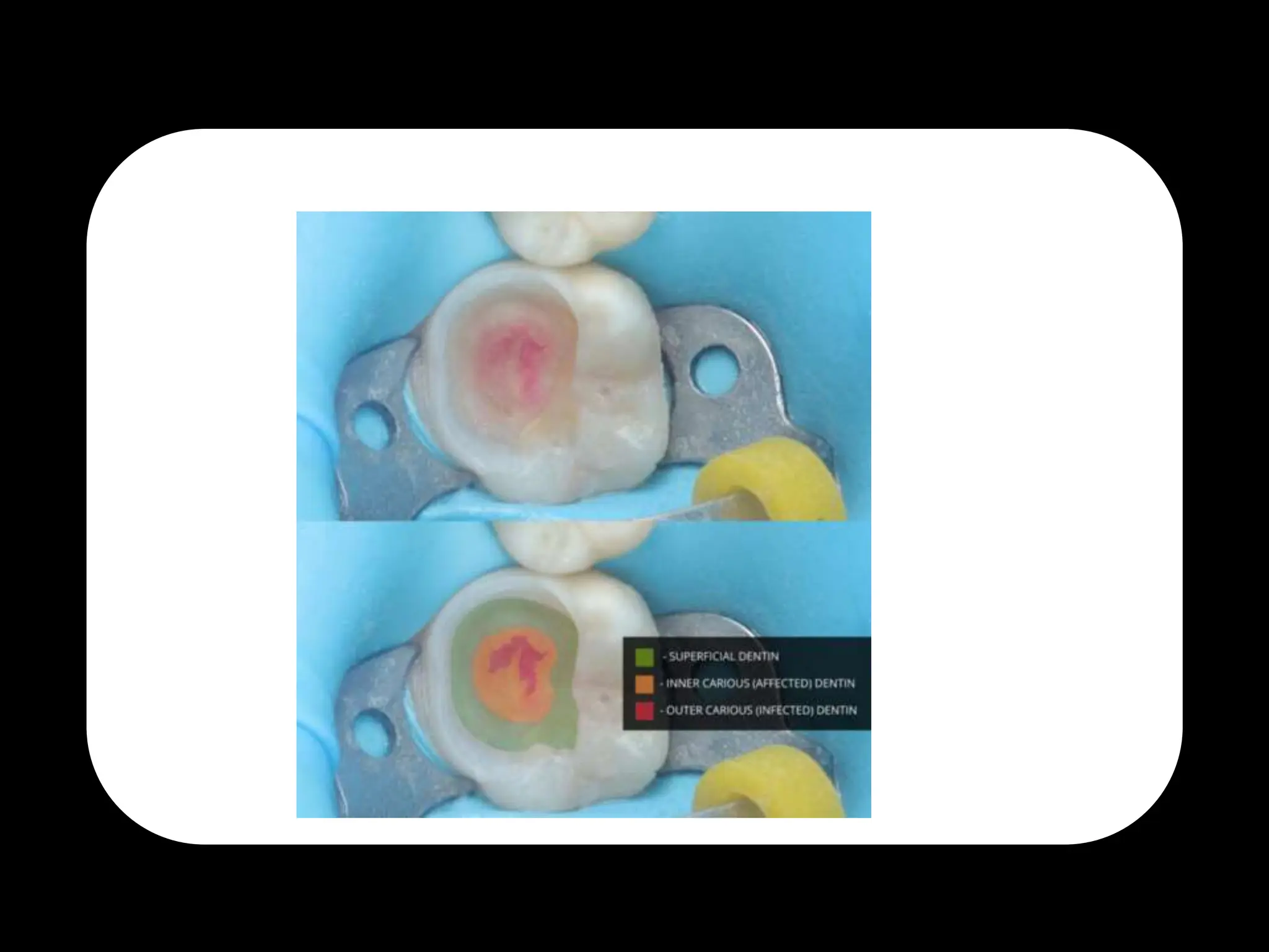 Endodontic Diagnosis. first part in diagnosispptx PPTX