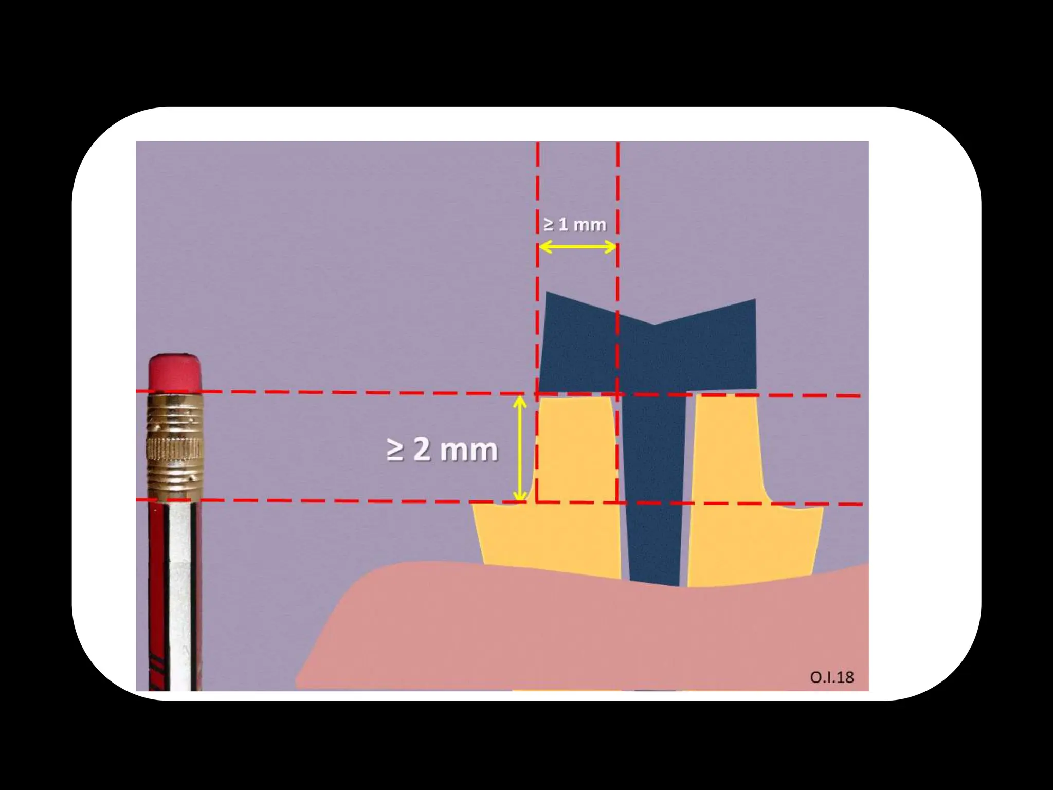 Endodontic Diagnosis. first part in diagnosispptx PPTX
