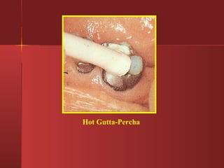 Hot Gutta-Percha 
 
