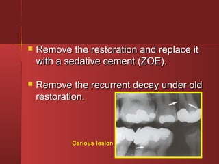  Remove tthhee rreessttoorraattiioonn aanndd rreeppllaaccee iitt 
wwiitthh aa sseeddaattiivvee cceemmeenntt ((ZZOOEE)).. 
 RReemmoovvee tthhee rreeccuurrrreenntt ddeeccaayy uunnddeerr oolldd 
rreessttoorraattiioonn.. 
Carious lesion 
 