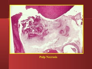 Pulp Necrosis 
 