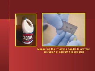 Measuring the irrigating needle to prevent 
extrusion of sodium hypochlorite 
 