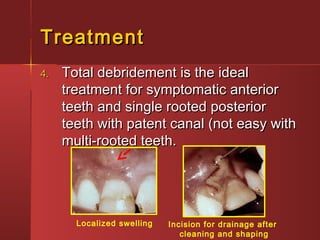 TTrreeaattmmeenntt 
44.. TToottaall ddeebbrriiddeemmeenntt iiss tthhee iiddeeaall 
ttrreeaattmmeenntt ffoorr ssyymmppttoommaattiicc aanntteerriioorr 
tteeeetthh aanndd ssiinnggllee rrooootteedd ppoosstteerriioorr 
tteeeetthh wwiitthh ppaatteenntt ccaannaall ((nnoott eeaassyy wwiitthh 
mmuullttii--rrooootteedd tteeeetthh.. 
Localized swelling Incision for drainage after 
cleaning and shaping 
 