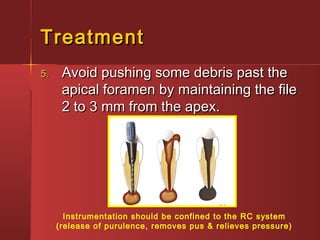 TTrreeaattmmeenntt 
55.. AAvvooiidd ppuusshhiinngg ssoommee ddeebbrriiss ppaasstt tthhee 
aappiiccaall ffoorraammeenn bbyy mmaaiinnttaaiinniinngg tthhee ffiillee 
22 ttoo 33 mmmm ffrroomm tthhee aappeexx.. 
Instrumentation should be confined to the RC system 
(release of purulence, removes pus & relieves pressure) 
 