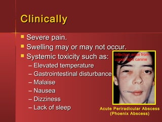CClliinniiccaallllyy 
 SSeevveerree ppaaiinn.. 
 SSwweelllliinngg mmaayy oorr mmaayy nnoott ooccccuurr.. 
 SSyysstteemmiicc ttooxxiicciittyy ssuucchh aass:: 
Infection arise from 
upper right canine 
– EElleevvaatteedd tteemmppeerraattuurree 
– GGaassttrrooiinntteessttiinnaall ddiissttuurrbbaannccee 
– MMaallaaiissee 
– NNaauusseeaa 
– DDiizzzziinneessss 
– LLaacckk ooff sslleeeepp Acute Periradicular Abscess 
(Phoenix Abscess) 
 